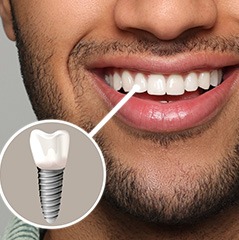 Man with beard smiling as with one tooth indicated as implant