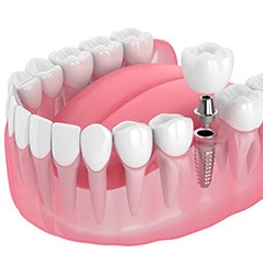 Rendering of single dental implant in lower arch with white background