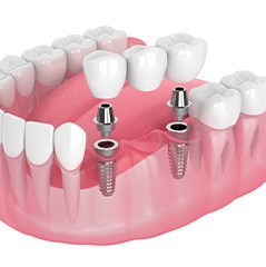 Rendering of implant bridge in lower arch with white background