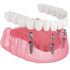 Rendering of implant dentures in lower arch with 4 posts and white background